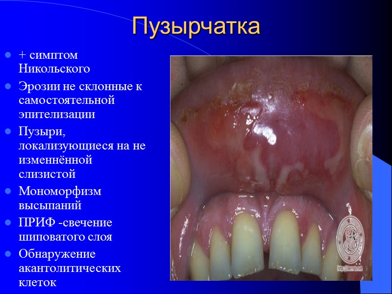Пузырчатка + симптом Никольского Эрозии не склонные к самостоятельной эпителизации Пузыри, локализующиеся на не